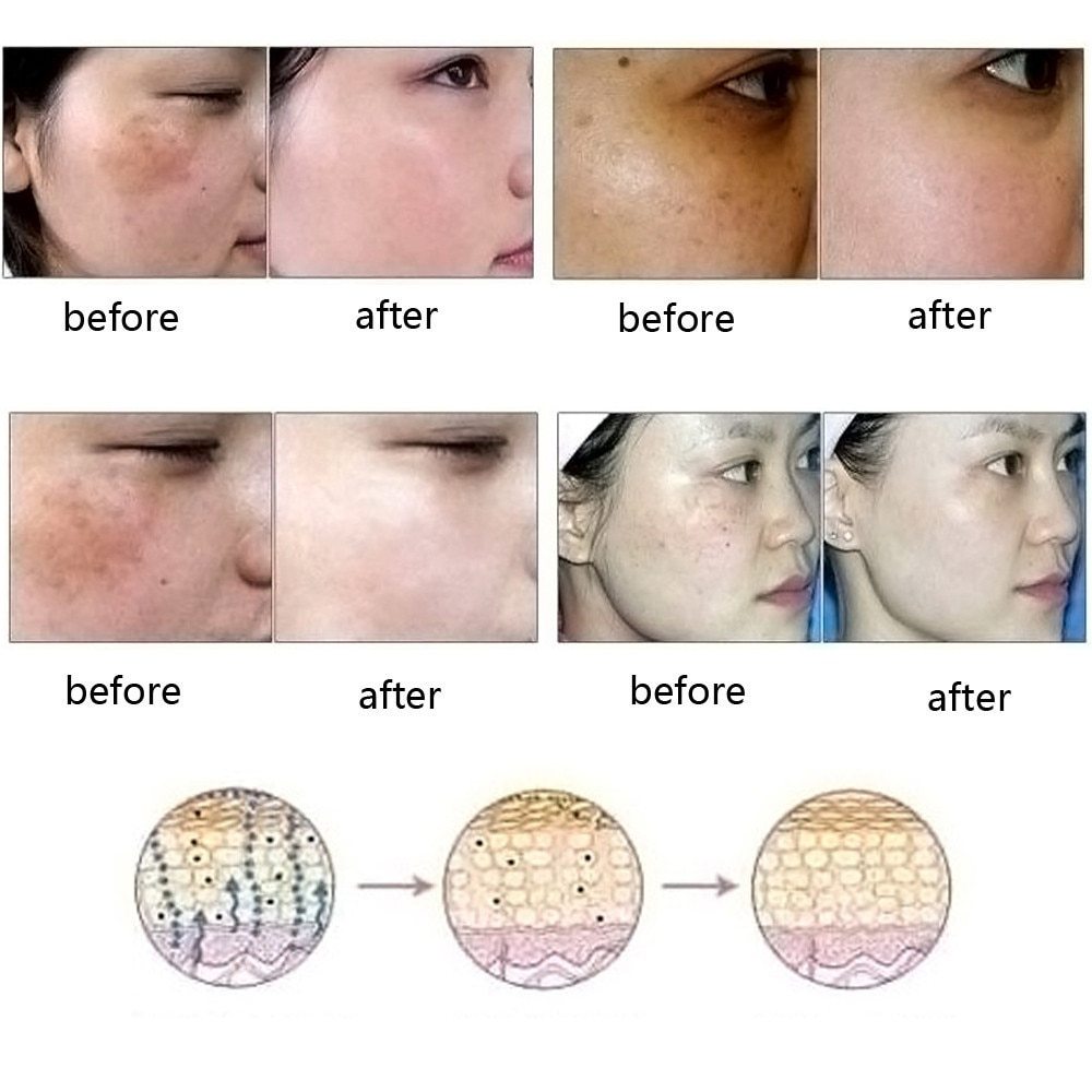 Dredge Meridian Natural Scar & Stretch Mark Removal Oil – Acne Care Essence CJ