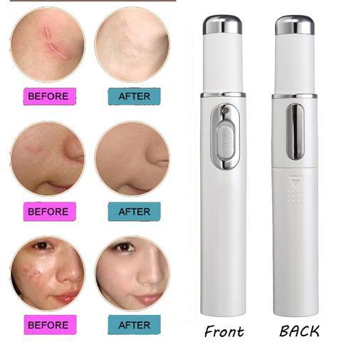 Blue Light Therapy Laser Pen – Acne & Wrinkle Treatment Renfan