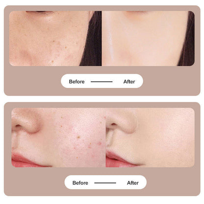 Tattoo & Mole Removal Plasma Pen – Laser Tool for Dark Spots, Freckles, and Wart Removal CJ