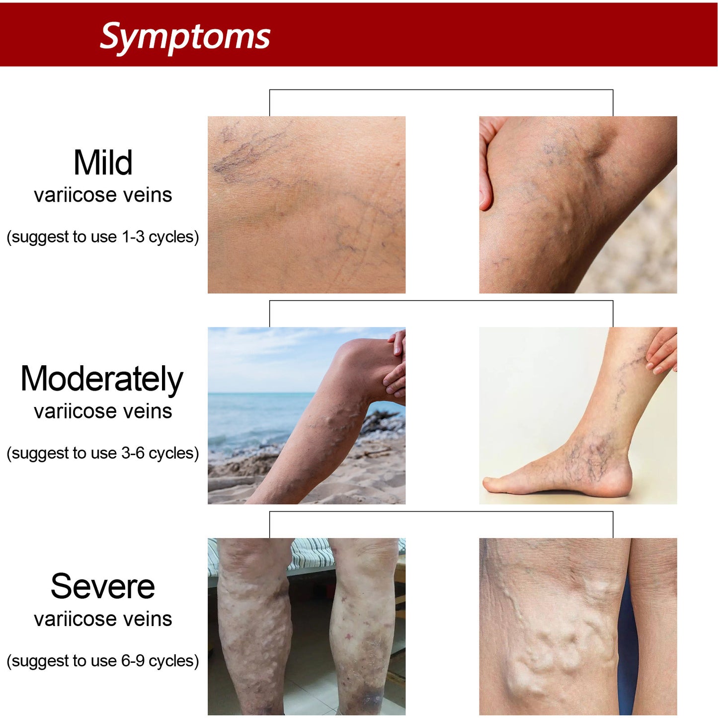 Earthworm Leg Vein Massage Cream – Relieves Varicose Veins and Reduces Leg Swelling