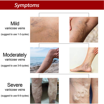 Earthworm Leg Vein Massage Cream – Relieves Varicose Veins and Reduces Leg Swelling