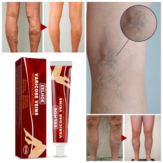 Earthworm Leg Vein Massage Cream – Relieves Varicose Veins and Reduces Leg Swelling
