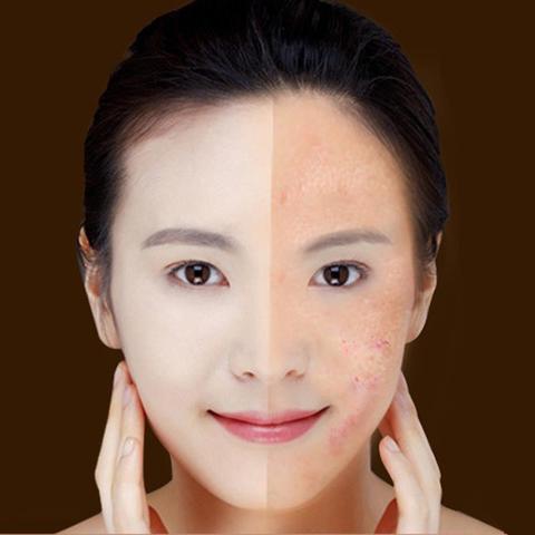 Blue Light Therapy Laser Pen – Acne & Wrinkle Treatment Renfan